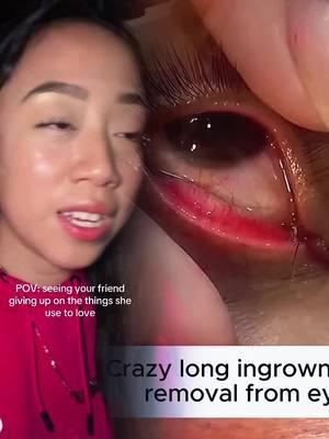 Ingrown eyelash removal with 25 gauge needle #ingrownhair #hairplucking #ingrowneyelash #lashes  #eyemucous #CleanTok #cleanmakeup #satisfyingvideo #asmr #eyemucous #cleaneyes #eyecleaning #sinkcleaningasmr #satisfying #asmrsound #asmr #cleanma  #fypage #fypシ゚ #fypツ #foryou #funny #skit #comedy #pov #fyp #foryou #tiktok #relatable 