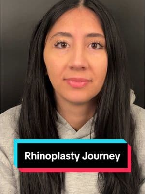 This patient is 1 year out from her #rhinoplasty looking absolutely amazing. She had a very difficult nose because it was quite large, and she also has very thick #skin. The #goals of the #rhinoplastysurgery were to reduce the hump, to refine the tip and to straighten the nose. I also did not want to widen the bridge on front view, which is a very difficult thing to do. In this #beforeandafter series and live video, you can see that her nose looks absolutely natural and has been reduced in size quite a bit. The front view is still narrow, and her tip has much more refinement and #symmetry. Long-term results really matter and that is why I like to show mypatients many months and many years after #nosesurgery.