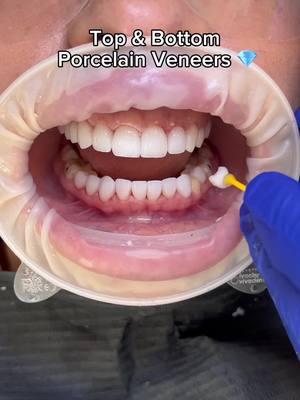 Top & Bottom Porcelain Veneers 💎 #veneers #dentalveneers #porcelainveneers #topandbottoms #veneerteeth #fyp #naturalsmile #veneerslosangeles 