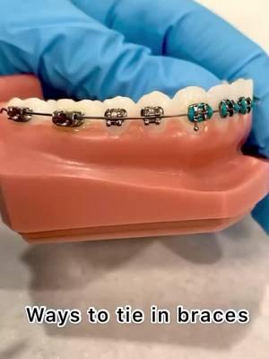 Fun fact Friday! 🧠 There are many different ways to tie in braces. How we want to move your teeth determines what we decide to use😬😁👍  #kriegersmiles #kriegerorthodontics #braces #orthodontics #orthodonticassistant #funfactfriday