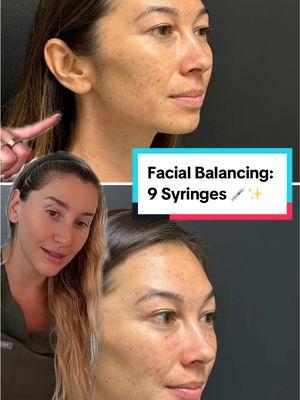 Chloe @Themedicalmind is here to spill the tea on a gorgeous facial balancing treatment she recently performed! Using 9 strategically placed syringes of filler, she enhanced her patient’s natural beauty while keeping the results subtle and undetectable. Facial balancing is all about creating harmony and symmetry—it’s not about changing your face, it’s about highlighting your unique features. Whether it’s adding volume to the cheeks, refining the jawline, or softening smile lines, every detail is customized to you. Natural-looking results that have people wondering, ‘What’s your secret?’ 💉💫 📍 Asia Pacific Plastic Surgery 📍 Honolulu, Hawaii #HawaiiMedSpa #DrShimChing #FacialBalancing #NaturalResults #HawaiiAesthetics #HonoluluMedSpa #GlowUpGoals #FillerTransformation #AestheticHarmony #ChloeInjects #FillerArtistry #SkinGoalsHawaii #FaceSymmetry #HawaiiGlow #SubtleEnhancements #FillerDoneRight #greenscreen 