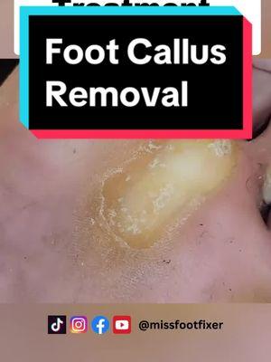 Best Callus Removal Techniques #callusremoval #missfootfixer #footcallusremoval #thickcallus 