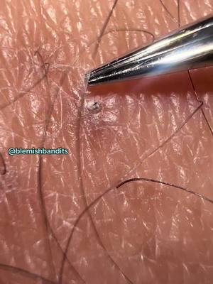 I just thought this was going to be a small pluck but I’m glad it wasn’t … enjoy 🤌🏽✨ . #creatorsearchinsights #blemishbandits #blemish #cloggedpores #ingrownhairs #extraction #pimple #acne #skincare #picking #xyzbca #skintreatment #skincareroutine #fyf #fypシ 