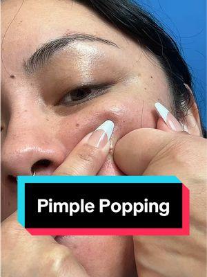 Replying to @apii85234  #pimplepopping #pimplepopperaddict #pimplepopper #acneproneskin #hormonalacne #peaceoutskincare @PeaceOutSkincare 