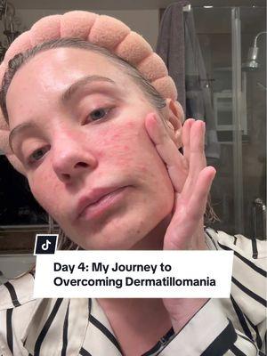 Day 4 of my journey to overcome dermatillomania and the fires are still burning here in LA. It’s been emotional, but I’m finding small ways to help, care for myself and stay grounded. Progress, not perfection. 🤍 #dermatillomania #skinpickingdisorder #journeytohealing #lafires 