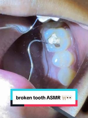 Oh my gawd my SHAYLA 😭#brokentooth #teeth #broken #asmr #dentalasmr #OhNo #shayla 