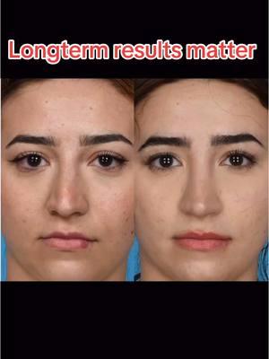 #longtermresults matter #drrodrohrich #bestplasticsurgeon @Newsweek #rhinoplasty #beforeandafter #fyp #foryoupage #rhinoplastybeforeandaafter #nose #deviatednose 