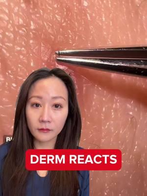 #ingrownhairs #hairextraction #ingrownhairtreatment #dermreacts #skincaretips #dermtok #skintok #dermatologist 