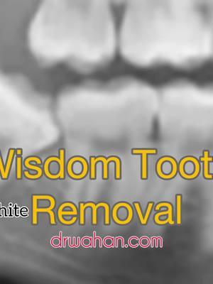 Quick Lower Wisdom Tooth Removal 🛠️🛠️Find these instruments at drwahan.com 🔊🔊Subscribe to my sweet video podcast at drwahan.com #wisdomtooth #oralsurgeon #dentalextractions #toothremoval #toothextraction 