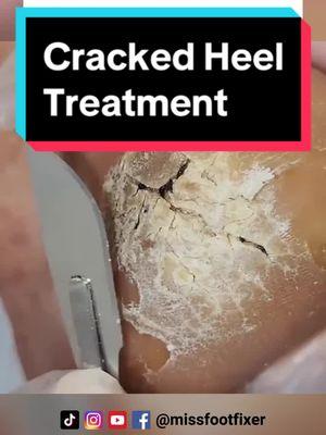 How to Treat Cracked Heels and Get Smooth Feet by Foot Specialist Miss Foot Fixer. #foottreatment #foottreatmentexper#missfootfixer #deadskinremoval #deadskinremover 