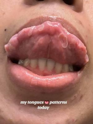 Lil patches errywhere 👅🤪 #geotongue #geographicaltongue #fissuers #fissuredtongue