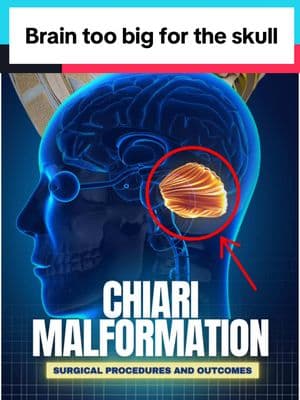 Chiari malformation is when the cerebellum protrudes through the base of the skull and can compromise local neurological structures. #chiari #chiarimalformation #brain #brainhealth #medical #medtok #doctorexplains 