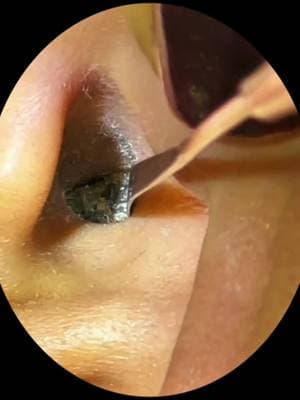 Take Earwax , Satisfying earwax Relaxing clean #earwax #ear #earwaxremoval #satisfying #satisfyingvideo #satisfyingvideos #clean #cleaning #cleaningtiktok #doctor #satisfaction