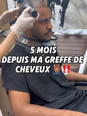 Déjà 5 mois depuis ma greffe de cheveux ‼️ #pourtoii #fyp #hairgrowth #hairtransplant #calvitie #greffedecheveux #chauve #poussedecheveux #alopecia #alopecie #france 