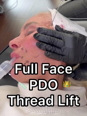 PDO Thread Lift: Your Non-Surgical Facelift Solution! 💫 Have you ever wondered how to achieve a lifted, youthful appearance without going under the knife? Let’s talk about the PDO Thread Lift, one of my favorite treatments for subtle yet stunning results! ✨ What is it? PDO threads are dissolvable sutures designed to lift sagging skin and stimulate collagen production. They work beneath the skin to give you a refreshed, natural-looking lift. ✨ Why choose PDO Threads? ✔️ Instant Lift: See results right away with continued improvement over months. ✔️ Non-Surgical: No scalpels, no downtime, no lengthy recovery. ✔️ Natural Results: Stimulates your body’s own collagen for long-term skin rejuvenation. ✔️ Customizable: Tailored to treat areas like the jawline, cheeks, brows, or neck! ✨ Who is it for? If you’re noticing early signs of aging—like sagging or volume loss—but aren’t ready for surgery, PDO threads might be your perfect match. 💡 Pro Tip: Pair your PDO threads with neurotoxins or fillers for a comprehensive facial transformation. 👉 Curious about how it works? Drop your questions below or DM me for a consultation! Let’s create the best version of YOU! 💖 #PDOThreads #ThreadLift #NonSurgicalFacelift #Aesthetics #SkinRejuvenation