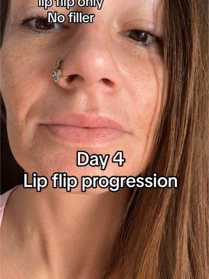 Replying to @Mel woke up today like a whole new woman w a whole top lip🤭😂 I LOVE IT LOL #lipflipprogress #lipflipday4 #day4 #lipflipcheck #lipflipresults #lipflipping #flipout #princessglitterhead 