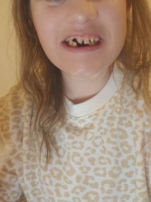 #smilemakeover #texassedationdental #ultimatesmilegiveaway #childhooddream #ectodermaldysplasia #allon4 #dentalimplants #trending #transition 