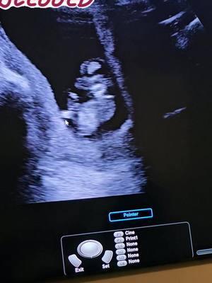 after she lost 3 babies in 2 different pregnancies, my daughter @.Dysennya. is welcoming her rainbow baby and 1st child in August of 2025. she's so active and was waving, grabbed her foot and was dancing for joy!  this ultrasound was an amazing experience cant wait to meet my grand daughter! #grandmasoftiktok #weloveyoualready #1stgrandbaby #rainbowbaby #ultrasound #mybabyishavingababy #pregnancy 