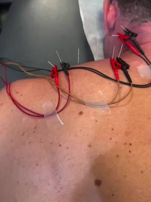 🏆 Dry Needling for Muscle Relief ▪️ What it does: Dry needling directly targets trigger points and areas of tension, releasing tight muscles, improving blood flow, and resetting muscle function. ▪️ The benefits: Get relief from chronic pain, improved range of motion, and faster recovery, so you can move better and feel stronger. ▪️ Who it’s for: Ideal for those dealing with stubborn knots, tightness, or pain from workouts, stress, or sitting too long. #DryNeedling #PainRelief #TriggerPointTherapy #MobilityRecovery #SportsChiropractor #RoscoeVillage #ChiropracticCare #ActiveRecovery #FunctionalMovement #MobilityTraining #AthleteRecovery #MuscleHealth #ChicagoChiropractor #InjuryPrevention #MovementMatters #DrKaitHoff #DrAdamAltman #DrKyleRoss