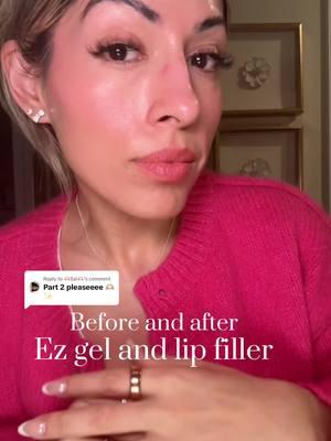 Replying to @🫶🏼Sal🫶🏼 forgot to do day 3-4. #ezgel #undereye #undereyebags #teartroughfiller #filler #lipfiller #prp #prf #beforeandafter 