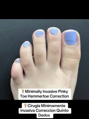 MINIMALLY INVASIVE CORRECTION OF THE NOTORIOUS “PINKY TOE” HAMMERTOES 🌟 👠Cosmetic Foot Surgery  🇪🇸Speak Spanish  🏖️Miami, Florida  ☎️954 922 7333 📍Link In Bio  #hammertoes #hammertoesurgery #dedosenmartillo #dedosengarra 