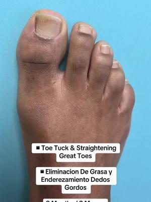 TOE TUCK SURGERY FOR “TOEBESITY”🌟 👠Cosmetic Foot Surgery  🇪🇸Speak Spanish  🏖️Miami, Florida ☎️954 922 7333 📍Link In Bio  #toetuck #toetucksurgery #toetucks #cosmeticfootsurgery 