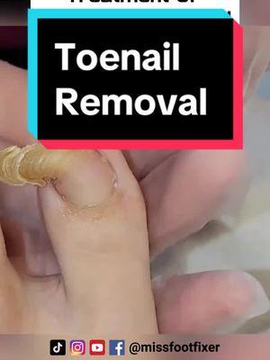 Ram's Horn Toenail: Causes, Treatment, and Prevention | Miss Foot Fixer #missfootfixer #toenailcare #toenailremoval #toenailfungus  #ramshornsnail 