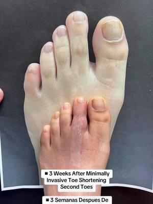 TRUST THE TOE SHORTENING PROCESS💫 👠Cosmetic Foot Surgery  🇪🇸Speak Spanish  🏖️Miami, Florida ☎️954 922 7333 📍Link In Bio  #footsurgery #toeshorteningsurgery 