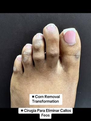 CORN REMOVAL TRANSFORMATION 🔥 👠Cosmetic Foot Surgery  🇪🇸Speak Spanish  🏖️Miami, Florida ☎️954 922 7333 📍Link In Bio  #cornremovalsurgery #cornremoval #pedicure 