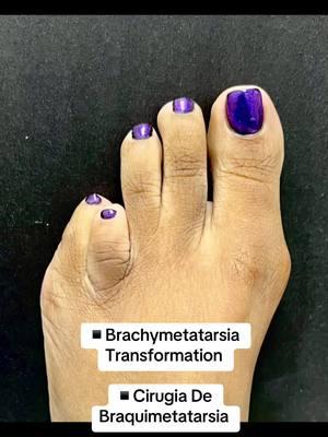 BRACHYMETATARSIA TRANSFORMATION 💖 👠Cosmetic Foot Surgery  🇪🇸Speak Spanish  🏖️Miami, Florida  ☎️954 922 7333 📍Link In Bio  #brachymetatarsia #braquimetatarsia #brachymetatarsiasurgery #toelengthening #toelengtheningsurgery 