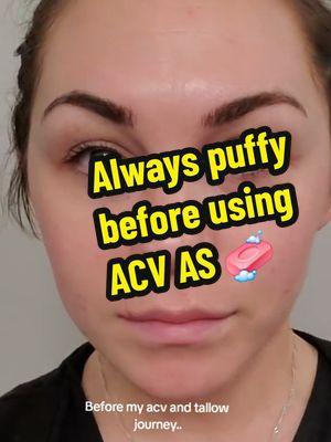 Inflammation, acne ,dark circles and pale was always so frustrating! Try these different tips on how to start your skincare journey with ACV --FREE DOWNLOAD IN BIO! #SKINCARE #acvtips #applecidervinegar  #acvsoap #puffyeyesolution 