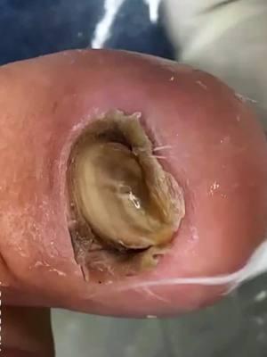 #ingrowntoenail #ingrowntoenailremoval #ingrownnail #ingrown #ingrowntoenailsurgery #infectedingrowntoenail #toenails #fyp #satisfying #usa_tiktok #usa🇺🇸 #nails #tiktokuk🇬🇧 #feetnails