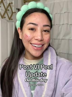 #onthisday throwback VI peel process 🐍 #chemicalpeeling #chemicalpeel #peeling #peelingskin 