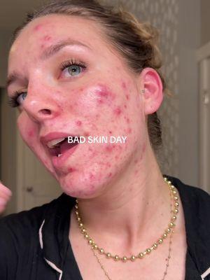 This is for anyone struggling with their skin today 🫶🏼  You are seen You are loved You are validated Keep fighting the good fight Acne SUCKS but it isnt forever We are in this together 💘 #cysticacne #acne #acneskin #acnepositivity #acneproneskin #acnefighter #MentalHealth #acnejourney 