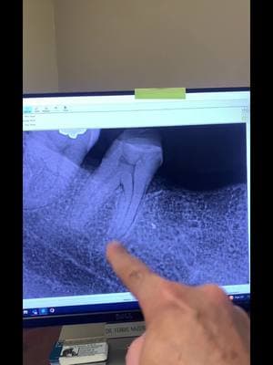 RCT of teeth #29 and #31 with 1.5 years follow up. #endodontist #rootcanal #dentist #dentists #dentalschool #dentalhygienist #dentalassistant #dentalstudent #tooth #teeth #dentistry #toothache 