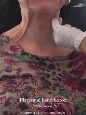 The Nefertiti Neck Lift, achieved through platysmal botox injections, is a non-surgical approach to refining the jawline and neck by targeting the platysma muscle. This thin, superficial muscle extends from the jawline to the clavicle and can contribute to visible neck bands, downward pull on the lower face, and loss of jawline definition with age. By injecting Botox along the platysmal bands and at key points along the jawline, the treatment relaxes the muscle’s downward tension, allowing the jawline to appear more lifted, sculpted, and defined. Functionally, this can also reduce platysmal hyperactivity, which may contribute to discomfort or excessive neck strain. The aesthetic outcome is a more youthful, elongated neck and improved jawline contour, akin to the regal profile of Queen Nefertiti. While results are temporary, lasting about three to four months, this treatment is a valuable option for those seeking a subtle yet effective rejuvenation without surgery. #beautyisinthedetails #devganoptimization #facialoptimization #boardcertifiedplasticsurgeon 