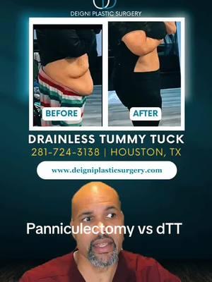 The #drainlesstummytuck gives a flatter belly and repairs the separation of ab muscles unlike the #panniculectomy #LIVEhighlights #TikTokLIVE #LIVE #deigniplasticsurgery #drdeigni #boardcertifiedplasticsurgeon #houstonplasticsurgeon #grateful #contentcreator #fyp #monsplasty 