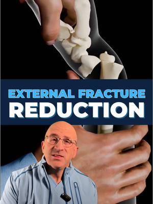 🦴 Fixing Broken Bones with External Reduction: "No Incision" Approach To Fractures . When you break a bone, getting it back into proper alignment is crucial for optimal healing. External reduction is a non-surgical technique where doctors manipulate #brokenbone fragments back into their correct position through careful, controlled movements - like solving a 3D puzzle, with precision and expertise. The procedure typically involves:   - Local anesthetic or nerve blocks to manage pain #OrthopedicCare   - Gentle traction to realign the bone fragments #FractureCare   - Real-time X-ray guidance for precise positioning   - Careful immobilization with a cast/splint External Reduction technique has evolved from ancient Egyptian practices to today's sophisticated methods using advanced imaging technology. While it might sound intimidating, external reduction often helps patients avoid surgery and promotes natural healing. The real magic happens in the first few weeks after reduction, as your body creates a natural scaffold around the break. This "callus" gradually transforms into new bone tissue, often resulting in a spot that's actually stronger than the original bone. External reduction typically works best for:   - Clean breaks without multiple fragments   - #Fractures that haven't broken through the skin   - Bones that haven't shifted too far out of position   - Patients who can't undergo surgery for medical reasons While not every fracture can be treated this way, external reduction remains a cornerstone of modern fracture care, offering a less invasive path to recovery for many patients. #brokenarm #wristfracture  . 👇 SHARE your broken bone experience & tips