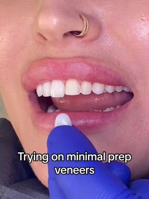 Minimal prep = very little shaving of your smile ! 🚫🪒Healthier teeth don’t require excessive amount of shaving in order to create a beautiful smile ! 📣 #minimalprepveneers #noshavingveneers #veneerteeth #veneertryon #tryonveneers #teethtransformation #naturalveneers 