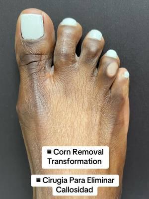 CORN REMOVAL SURGERY🤩 👠Cosmetic Foot Surgery  🇪🇸Speak Spanish  ☎️954 922 7333 🏖️Miami, Florida  📍Link In Bio  #cornremovalsurgery #cornremoval #callosidad #toecorn #toecorns 