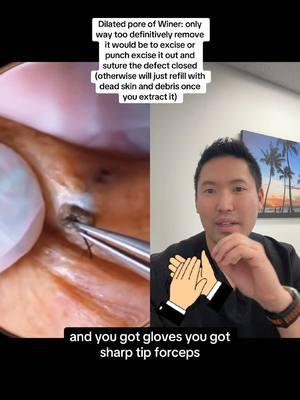 #duet with @Pimple Pro #squeeze not showing us the entire video was criminal 😩😆😭 #extraction #cystpop #cystextraction #poreextraction #cloggedpores #dilatedporeofwiner #dilatedpores #drsugaiskincare #pimplepop 