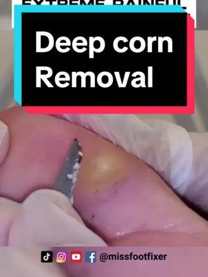 EXTREME PAINFUL DEEP CORN ON TOE 2025 PROPER TREATMENT BY FAMOUS PODIATRIST MISS FOOT FIXER #cornhole #deepcorn #missfootfixer #cornremoval #skinremovalsurgery 