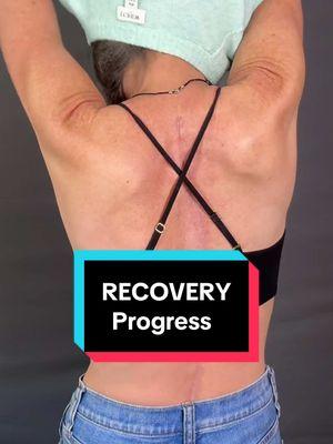 #scoliosischeck #scoliosissurgery #spinalfusionrecovery #spinalfusion #spinesirgery #backsurgery #backrecovery #scoliosis #scar #scoliosisscar #beforeafter #scoliosiswarrior 