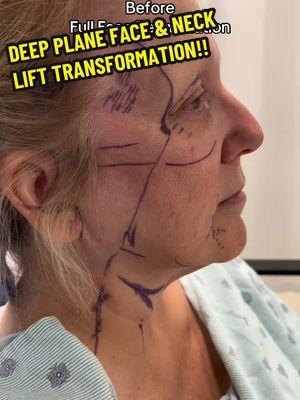 “This was the best decision ever I wish I had done my facelift years ago!!! Dr. Kassir you truly are an artist and made me look 20 years younger! I can not thank you enough for changing my life ❤️” says our lovely patient 3 months post-op 😍 Our amazing 59 year young patient came from North Carolina for facial rejuvenation. She didn’t want to look like a different person or “too pulled” she wanted to look refreshed and youthful.  Concerns ⬇️ - She disliked her droopy midface  - Forehead wrinkles  - Excess neck skin  - Heavy brows  Game Plan ⬇️ We performed the following procedures to give her a natural & fresh look: 1️⃣ Deep Plane Face & Neck Lift 2️⃣ Endoscopic Brow Lift 3️⃣ Upper & Lower Blepharoplasty  4️⃣ Filler Removal 5️⃣ Fat Transfer to Face 6️⃣ CO2 Fractional Laser  She is now 3 months post-op and is in love with her results! She feels great & love how natural her results are. We will continue to keep track of her healing and show you all the progress! Stay tuned for her follow up pictures 🤗 To schedule an appointment:   ☎️ 212-288-3000  📲 WhatsApp: 201-875-8482 💌DM  Locations: 📍65 East 66th Street, New York, NY 10065 📍81 North Maple Avenue, Ridgewood, NJ 07450 #bestfacelift #facelift #faceliftnyc #faceliftnj #necklift #faceliftbeforeandafter #over50 #faceliftjourney #faceliftrecovery #beforeandafterfacelift #faceliftrecovery  #scarsafterfacelift #viral  Disclaimer: I do not own or claim to own the audio in this video. All rights and permissions are granted to the owner of this sound.