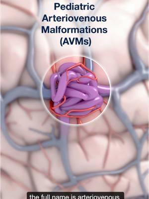 @UCSF Health experts explain what an arteriovenous malformation (#AVM) is. Our Pediatric Cerebrovascular and Stroke Program at @UCSF Benioff Children’s offers specialized care for complex pediatric neurovascular conditions.  #AVM #AVMAwareness #ArteriovenousMalformation #UnitedandRare #neurosugery #SciArt #MedicalArt #MedicalIllustration 