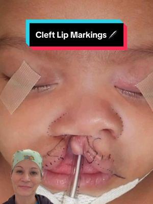 Hi 👋🏼 everyone!  It’s #markingsmonday!! 🖊️🖊️ Why do I post cleft lip marking videos? 🤔 Watch 👀 this video 🎥 to hear why!  It is important to keep in mind that EVERY cleft patient has unique anatomy. Therefore my markings 🖊️ for each repair are different in each case, which ultimately leads to  a unique surgery each and every time. 👍🏻 Stay tuned for updates on this baby’s progress! As always, leave your questions and comments below. 👇🏼 Goal: To help make children WITH clefts look like children WITHOUT clefts. 😄 Mission: Transforming children’s lives one smile at a time. 👍🏼 These images are the property of Dr. Rachel A. Ruotolo and NYPSG and are not authorized for use by any other party. This is my actual patient with real results who has given informed consent (directly or indirectly via parents) to appear on my website and social media pages. #makingsmiles #cleftliprepair #cleftpalate #cleftlip #cleft #plasticsurgeryresident #craniofacialfellow 