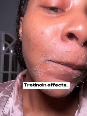 Love hate relationship with miss Tretinoin 😭💕 #tretinoin #tretinoinpurge #tretinoinjourney #skincare 