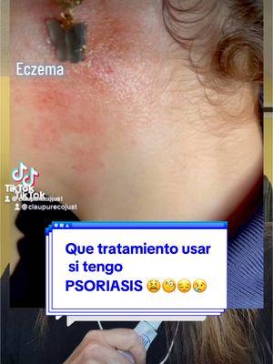 Respuesta a @AelB #dondecomprolosproductosjust VE A MI #perfilclaudiapurecojust Y DALE CLICK EN #linktreeclaudiapurecojust #psoriasis #eczema #DERMATITIS #NINOS #ADULTO 