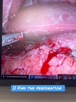 Perforated gastric ulcer - patients come in septic/incredibly ill… and leave with 3-4 tiny  incisions after a quick 20-30 minute robotic surgery. No massive incision necessary! #generalsurgery #pepticulcerdisease #sepsis #peforation #dallassurgeon 