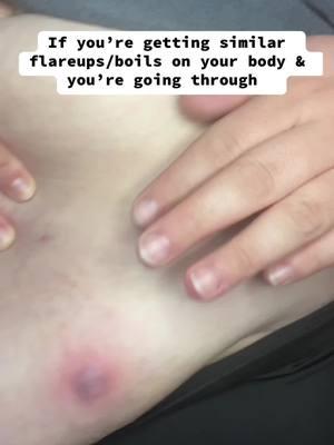 Check out my ALL NATURAL products in my bio to help with these skin irritations 🤍🪴 #bespokenholistics #allnatural #holistichealing #holistic #essentialoil #herbalmedicine #flareups #herbs #bodybumpoil #draining #holisticproducts #Loveyourboobs #CapCut 